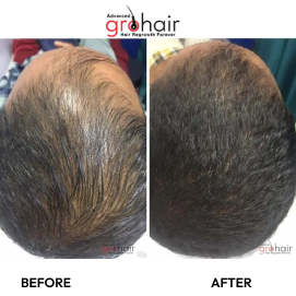 Non-Surgical Hair Loss