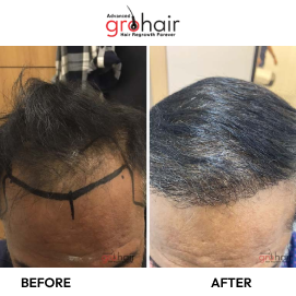 Non-Surgical Hair Loss