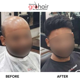 hair transplant treatment