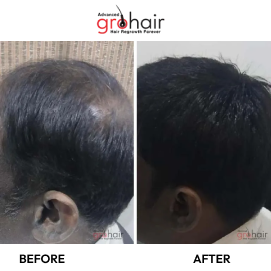 hair transplant service